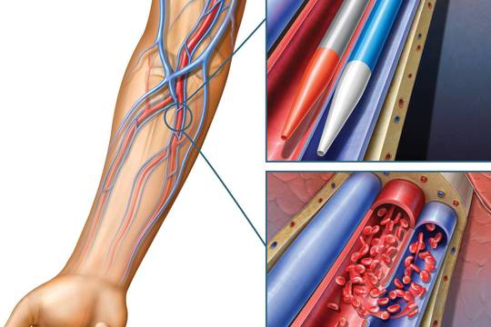 fistula for dialysis placement