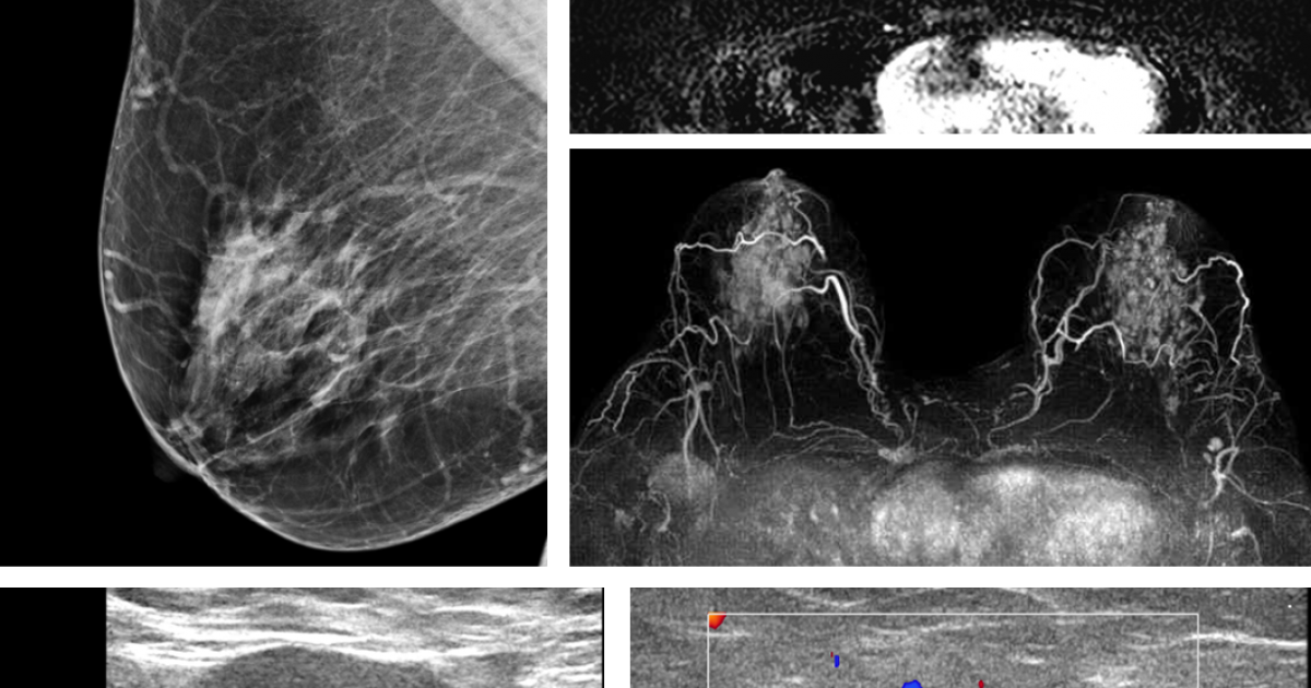 Breast Imaging | Department of Radiology | The University of